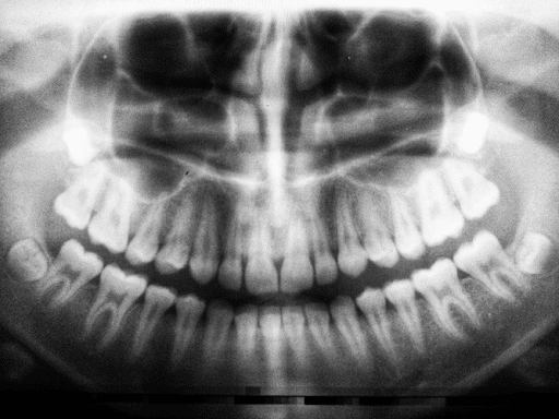 an x-ray of someone's teeth with wisdom teeth coming in